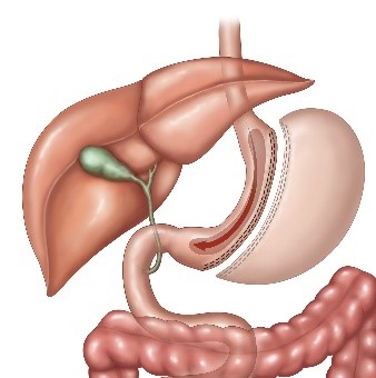 Sleeve Gastrectomy