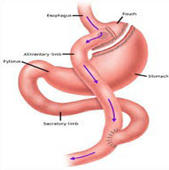 weightloss-surg05n