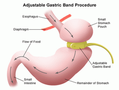 Adjustable gastric banding