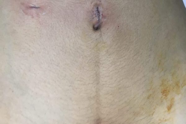 lap appendicectomy incision port
