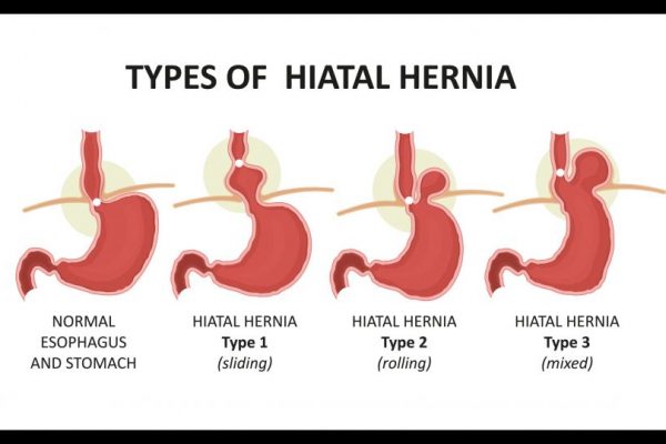 Typrs hiatal hernia